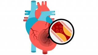 Ilustración de un corazón con una lupa que amplía una arteria obstruida