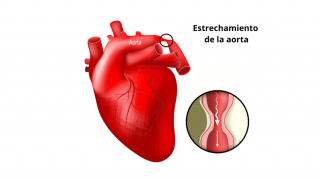 Ilustración de un corazón y al lado una lupa que amplía la arteria aorta estrechada