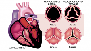 ilustración de corazón con partes diferenciadas por colores y a la derecha las válvulas abiertas y cerradas, sanas y enfermas