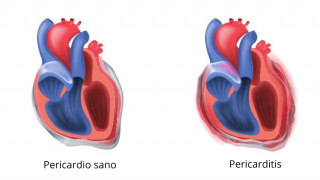 Ilustración de dos corazones con un velo alrededor inflamado y rojizo