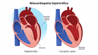 Ilustración de dos corazones con ventrículo izquierdo más ancho en uno de los corazones