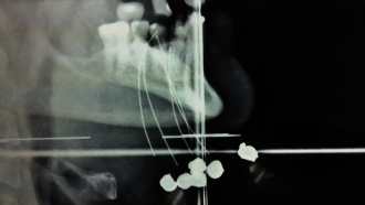 radiografía de mandíbula y cuello donde se ve unas líneas que atraviesan la mandíbula con unas bolitas en los extremos