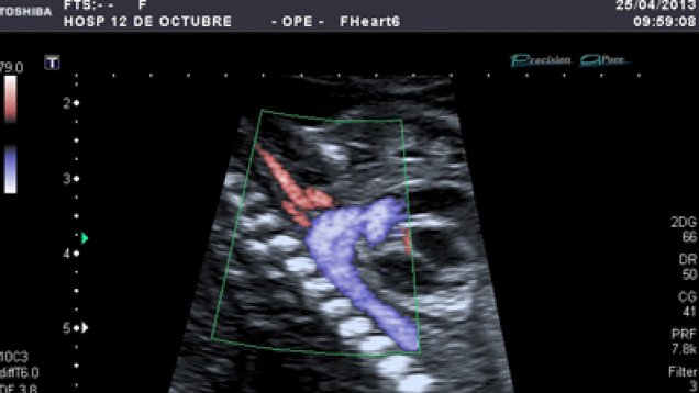Arco aórtico fetal