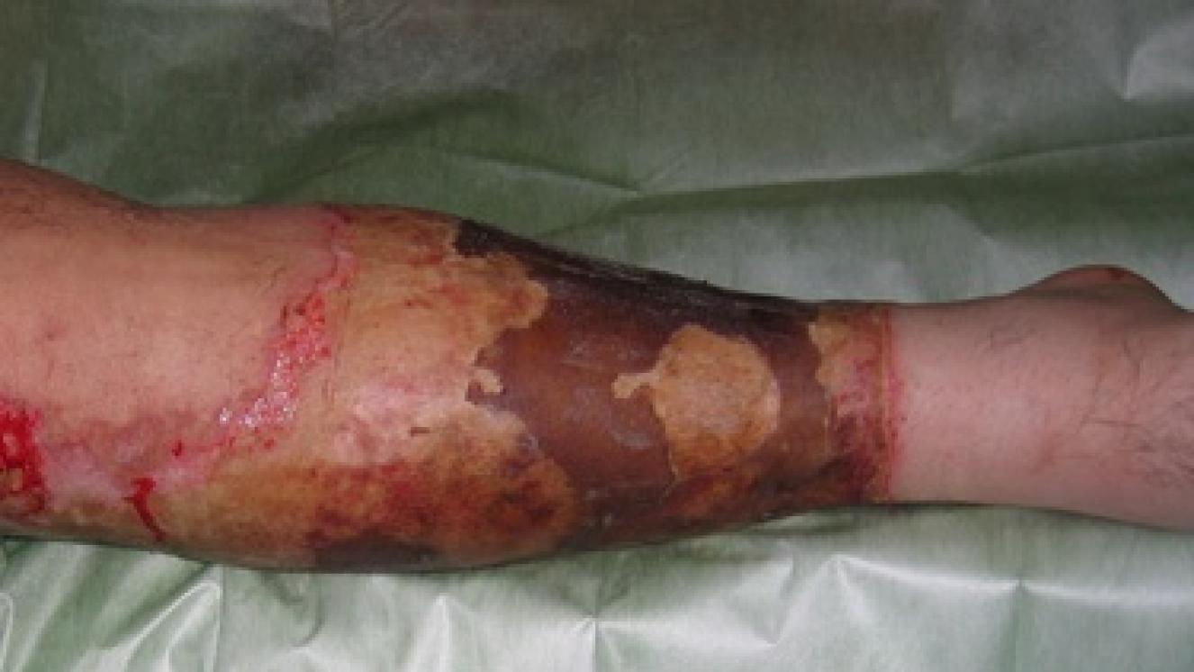 Quemadura de grado III en la pierna producida por llama