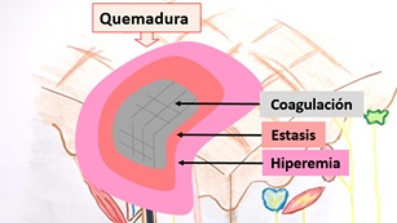 Zonas de coagulación, éstasis e hiperemia de una quemadura