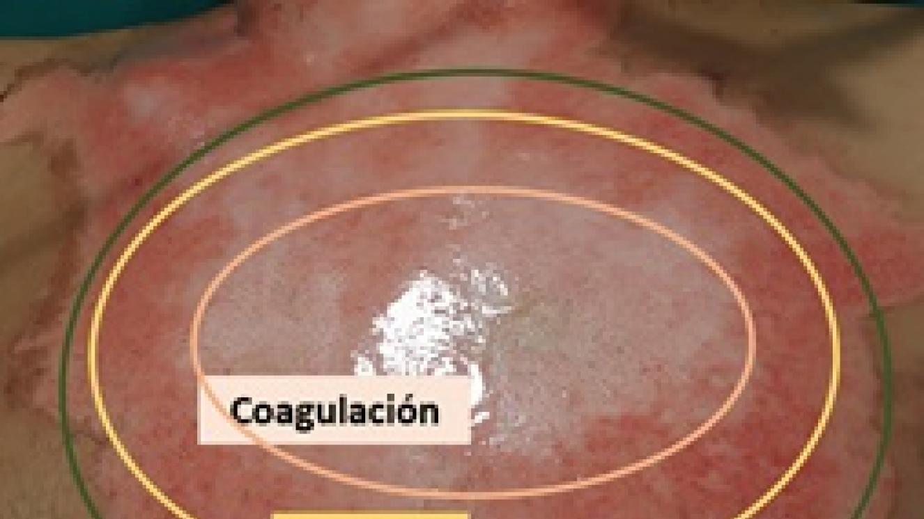 Quemadura con zona de coagulación, éstasis e hiperemia