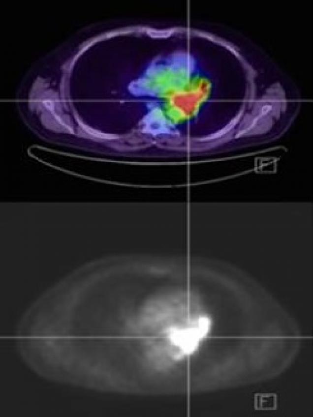 fusión de imágenes SEPT y/o PET con TAC y RM diagnóstico Medicina Nuclear