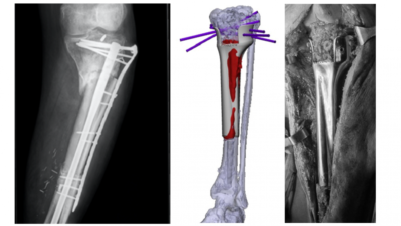 Imagen radiográfica,reconstrucción 3D y fotografía intraoperatoria con el implante fijado