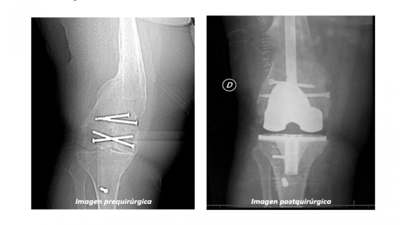 Radiografía del paciente previa y posterior a la cirugía