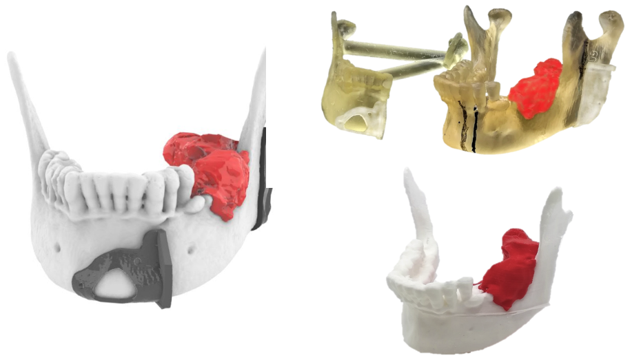 Planificación virtual. Guías quirúrgicas sobre el biomodelo mandibular y biomodelo con las osteotomías de entrenamiento previas a la cirugía fabricadas con tecnología SLA.  Biomodelo impreso en tecnología FDM.
