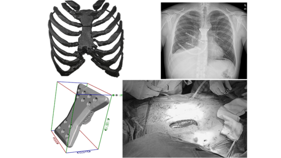 Biomodelo impreso en 3D, diseño de implante a medida, imagen postoperatoria