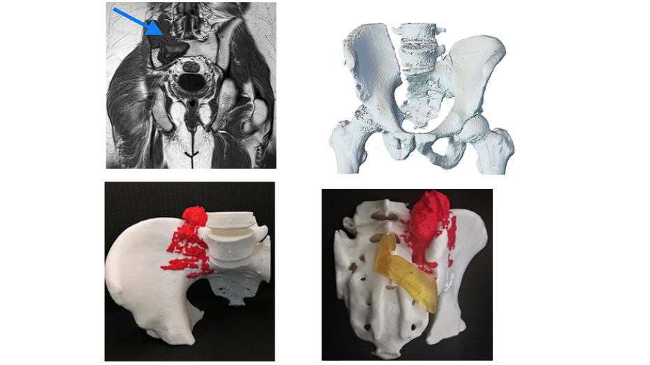 Imagen radiológica pre y postoperatoria, biomodelo impreso bicolor y guía quirúrgica