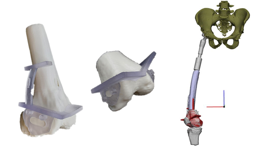 Biomodelos del fémur y del injerto con sus correspondientes guías de osteotomía impresos 3D y control virtual postquirúrgico
