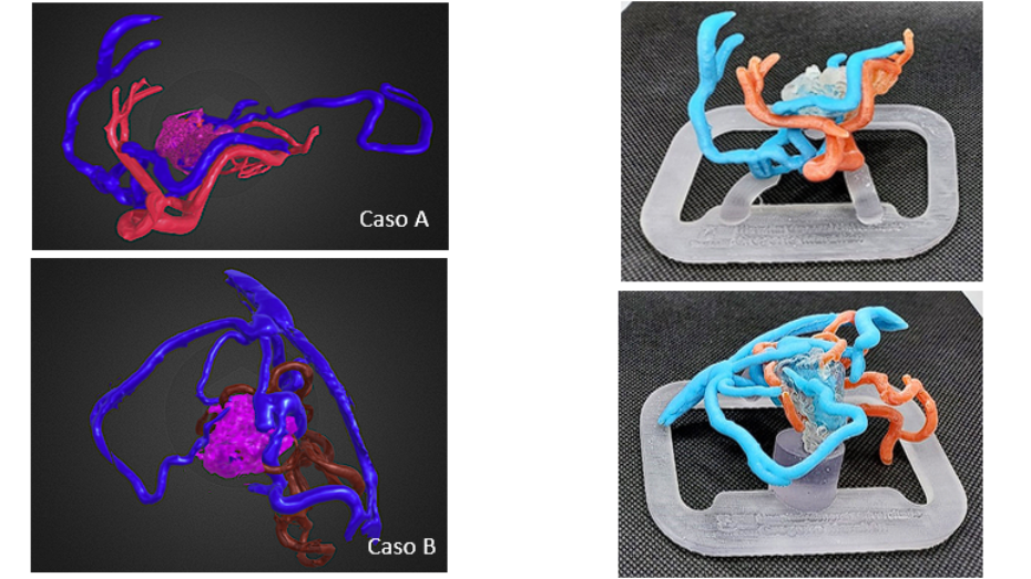 Modelos 3D virtuales de las malformaciones e impresión 3D de los biomodelos mediante tecnología PolyJet