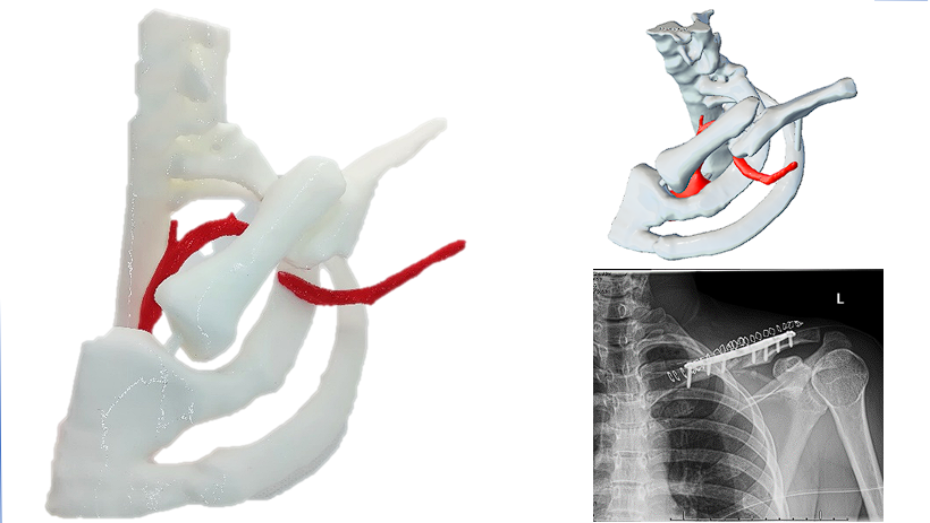 Biomodelo bicolor, modelo virtual e imagen radiológica postquirúrgica