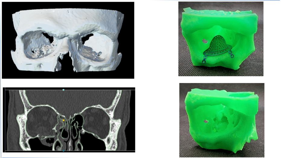 Modelo 3D virtual, imagen radiológica, biomodelo con la malla de titanio preformada y con la fractura
