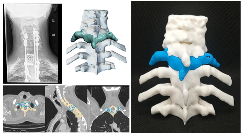 Imagen radiológica postoperatoria, modelo virtual, imagen segmentada y biomodelo impreso en 3D