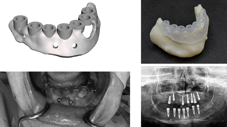 Diseño de la guía, biomodelo y guía quirúrgica impresos en 3D, imagen intraoperatoria e imagen postquirúrgica