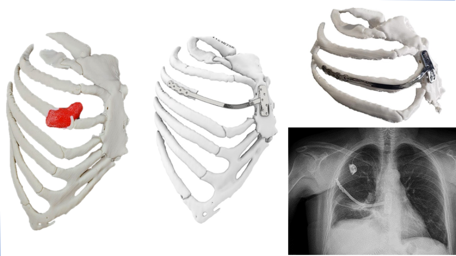 Biomodelo con Sarcoma Edwin, diseño implante, biomodelo con implante impreso en 3D, imagen postqx