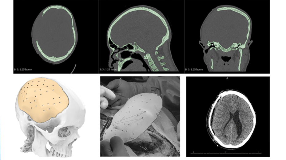Imagen prequirúrgica, diseño de craneoplastia del cráneo, craneoplastia en PEEK, imagen postquirúrgica