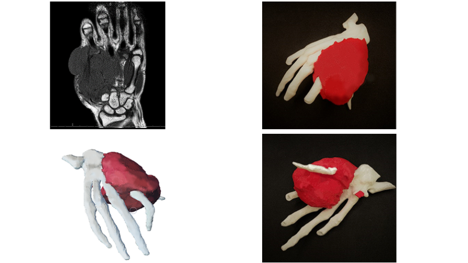 Imagen radiológica, modelo 3D virtual, biomodelo impreso en 3D