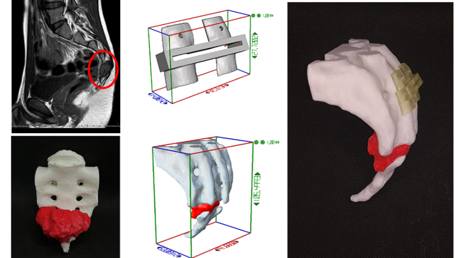 Imagen radiológica preqx, diseño de guía quirúrgica, modelo 3D virtual, biomodelo impreso 3D y guía impresa en 3D ajustada al biomodelo