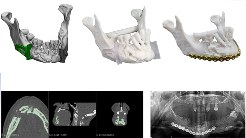 Diseño virtual, Biomodelo 3D y guías quirúrgicas, premoldeado de placa, imagen radiológica pre y postquirúrgica