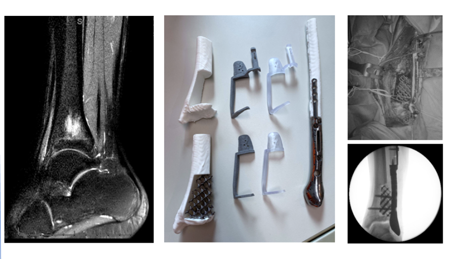 Imagen radiológica prequirúrgica, biomodelo 3D y guías quirúrgicas con el implante, implante colocado e imagen postquirúrgica