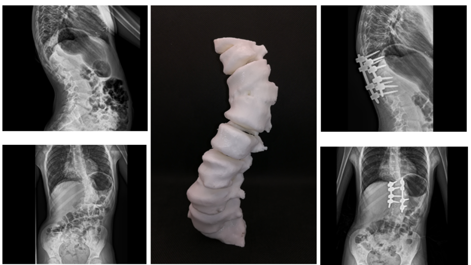 Imagen radiológica prequirúrgica, biomodelo impreso en 3D, imagen radiológica postquirúrgica