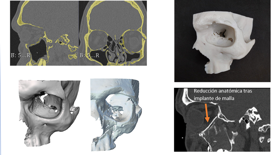 Imagen radiológica prequirúrgica, modelo virtual e imagen especular, biomodelo imagen especular impreso en 3D, imagen radiológica postquirúrgica 