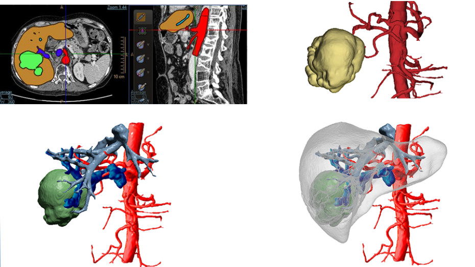 Segmentación imagen radiológica, modelo 3D virtual