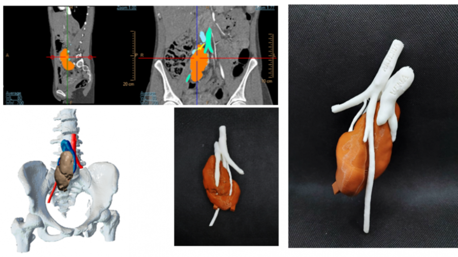 Segmentación imagen radiológica, modelo 3D virtual, biomodelo impreso en 3D