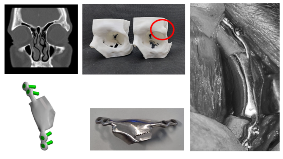 Imagen prequirúrgica, biomodelo del defecto y de la imagen especular impreso en 3D, diseño virtual del implante, implante impreso en 3D en titanio, imagen quirúrgica