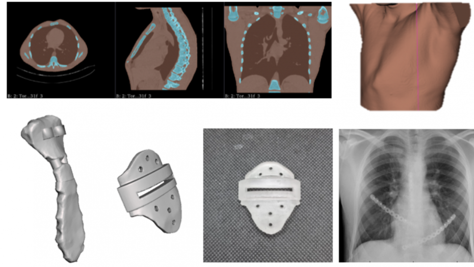 Segmentación imagen radiológica, modelo virtual del tórax, esternón y guía quirúrgica, guía impresa en 3D, imagen postquirúrgica