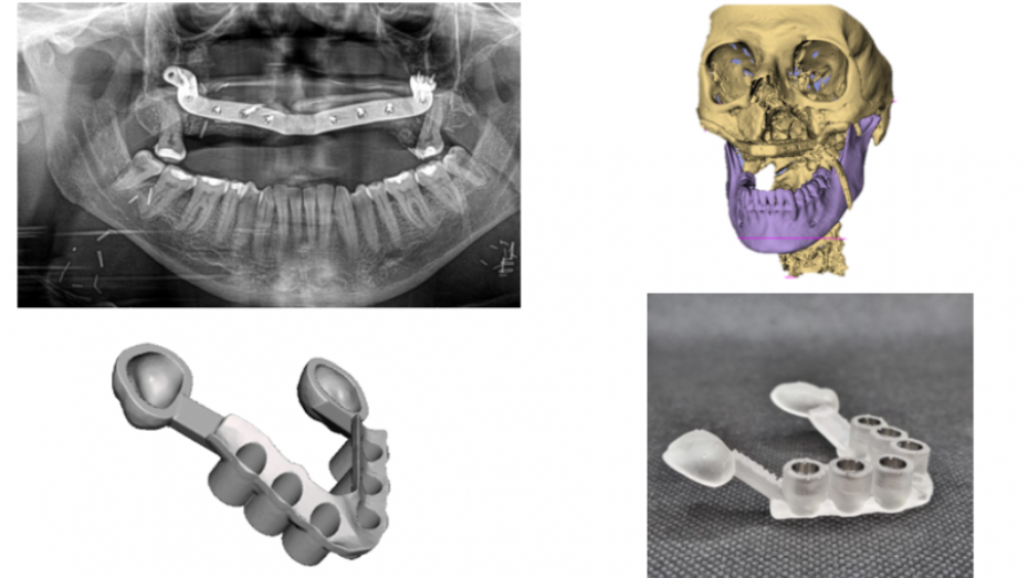 Imagen radiológica prequirúrgica, modelo 3D virtual del cráneo y de la guía, guía impresa en 3D