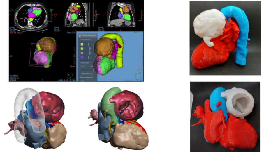 Segmentación imagen radiológica, modelo 3D virtual, biomodelo impreso en 3D