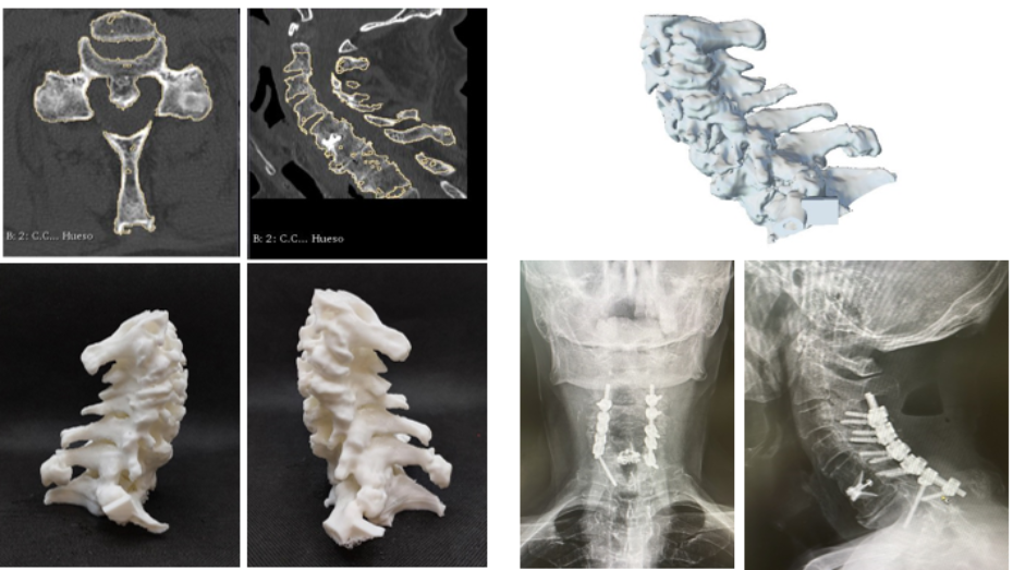 Segmentación imagen radiológica, modelo virtual 3D, biomodelo impreso en 3D, imagen post quirúrgica