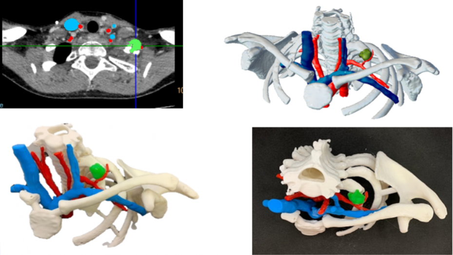Segmentación imagen radiológica, modelo virtual 3D, biomodelo impreso 3D