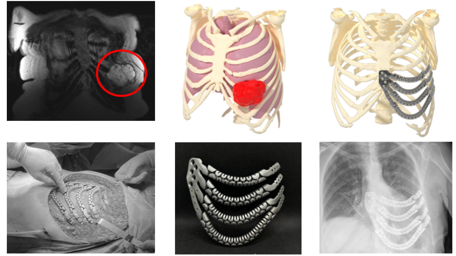 Imagen radiológica prequirúrgica, modelo virtual 3D, biomodelo impreso 3D, imagen quirúrgica, imagen implante impreso, imagen radiológica postquirúrgica