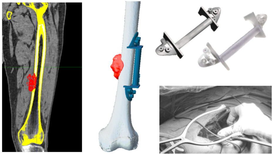 Imagen radiológica prequirúrgica, modelo virtual 3D, modelo guía virtual, guía impresa 3D, imagen quirúrgica