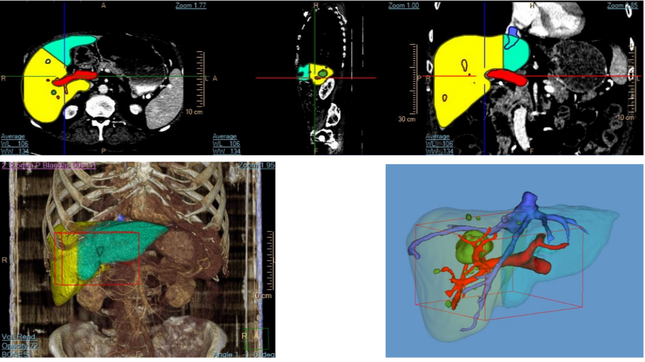 Imagen radiológica prequirúrgica, modelo virtual 3D