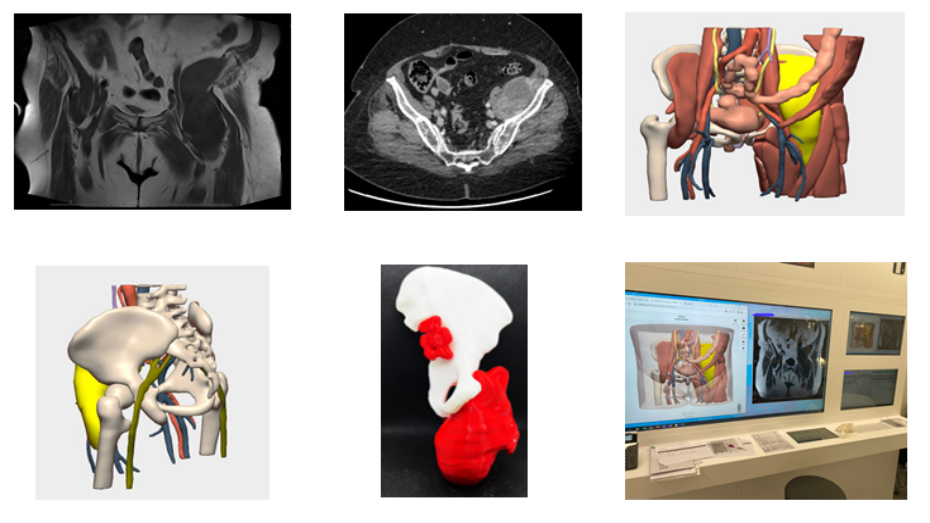 Imagen radiológica prequirúrgica, modelo virtual 3D, biomodelo impreso en 3D, visualización imagen en quirófano híbrido