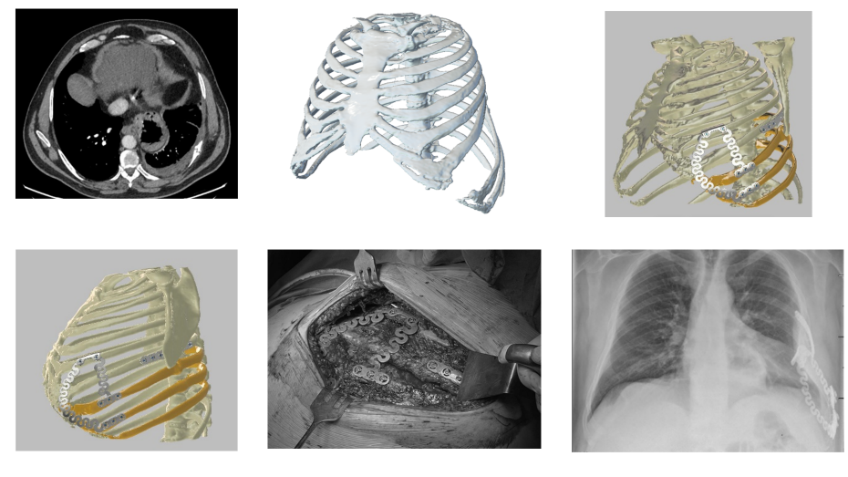 Imagen radiológica prequirúrgica, modelo virtual 3D, modelo virtual implante personalizado, imagen quirúrgica, imagen postquirúrgica