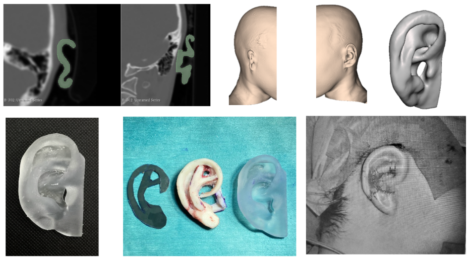 Segmentación imagen radiológica prequirúrgica, modelo virtual 3D, modelo guía virtual, guía impresa 3D, imagen quirúrgica