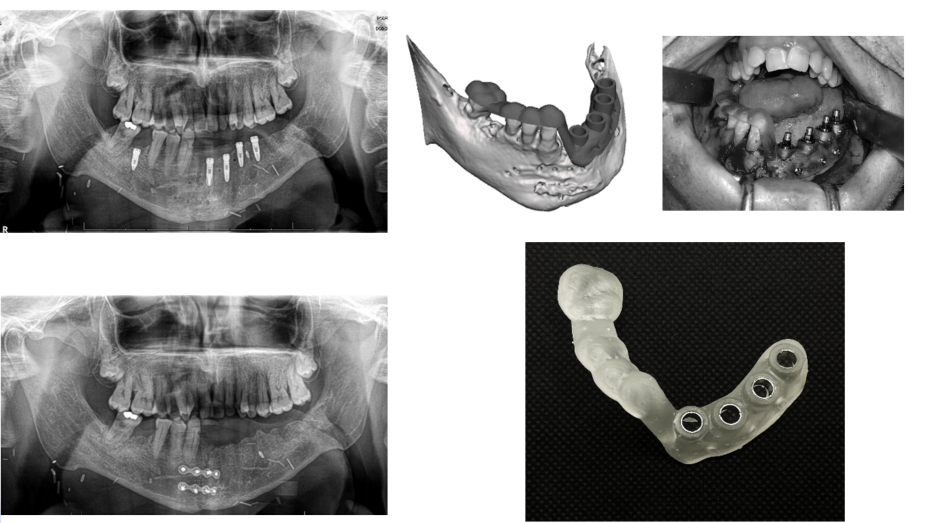 Imagen radiológica prequirúrgica, modelo virtual 3D, imagen quirúrgica, imagen postquirúrgica, guía impresa