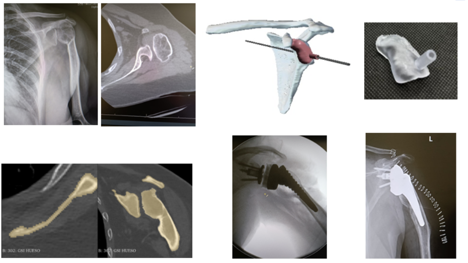 Imagen radiológica preoperatoria, modelo virtual 3D del hueso y diseño guía, guía impresa, segmentación hueso, imagen radiológica intraoperatoria, imagen radiológica postoperatoria