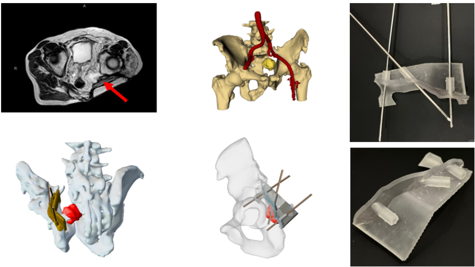 Imagen radiológica, modelo virtual 3D, guías quirúrgicas impresa 3D