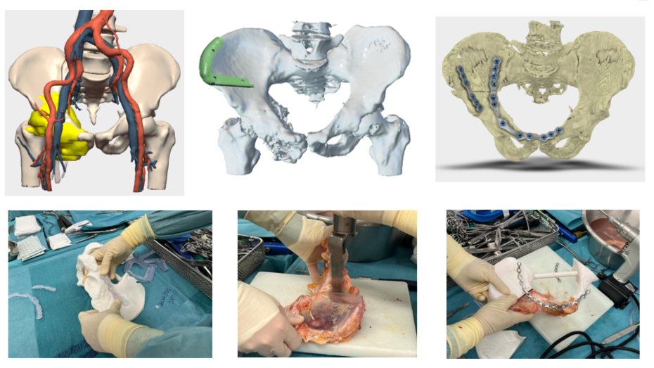 Modelo virtual 3D, modelo virtual 3D con guía de corte, modelo virtual con placas diseñadas, imágenes durante la cirugía