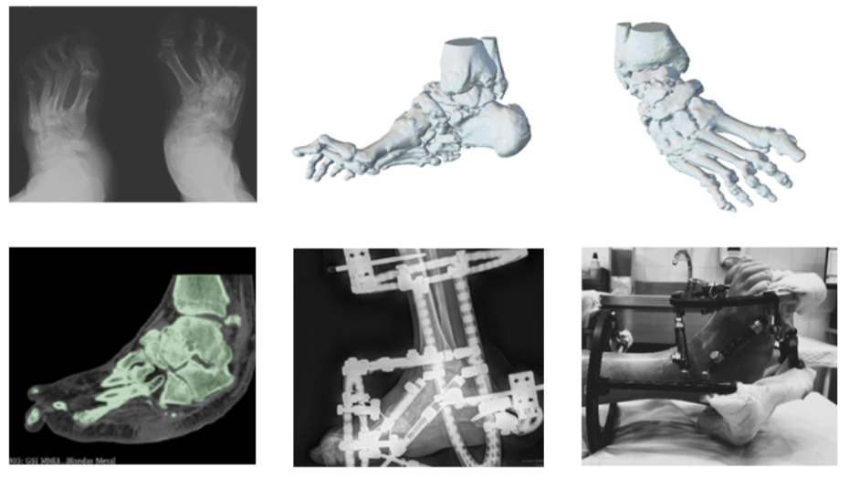Imagen radiológica de los pies, modelo 3D virtual, segmentación 3D del pie, imagen radiológica con fijador externo, imagen real