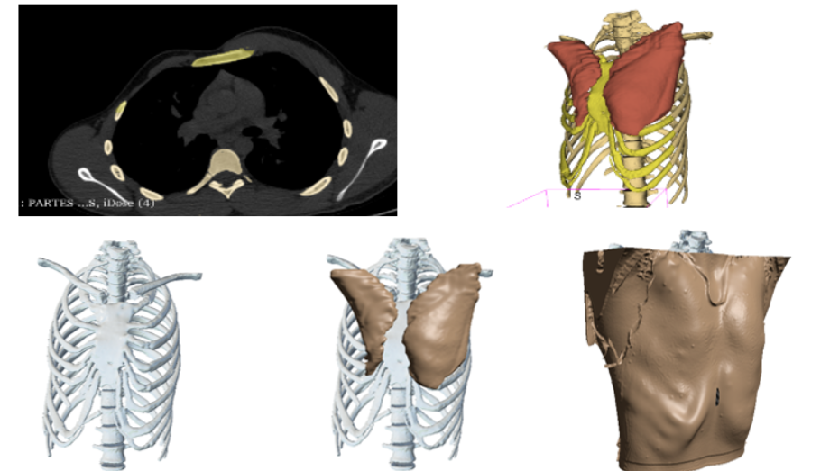 Imagen radiológica prequirúrgica, modelos virtuales 3D